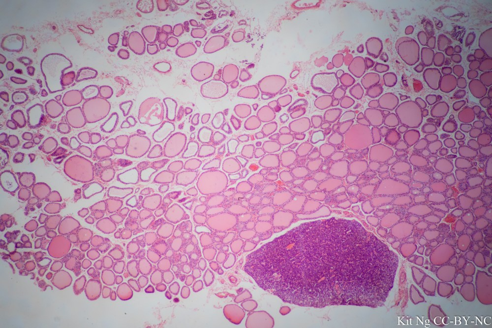 Parathyroid and Thyroid-3