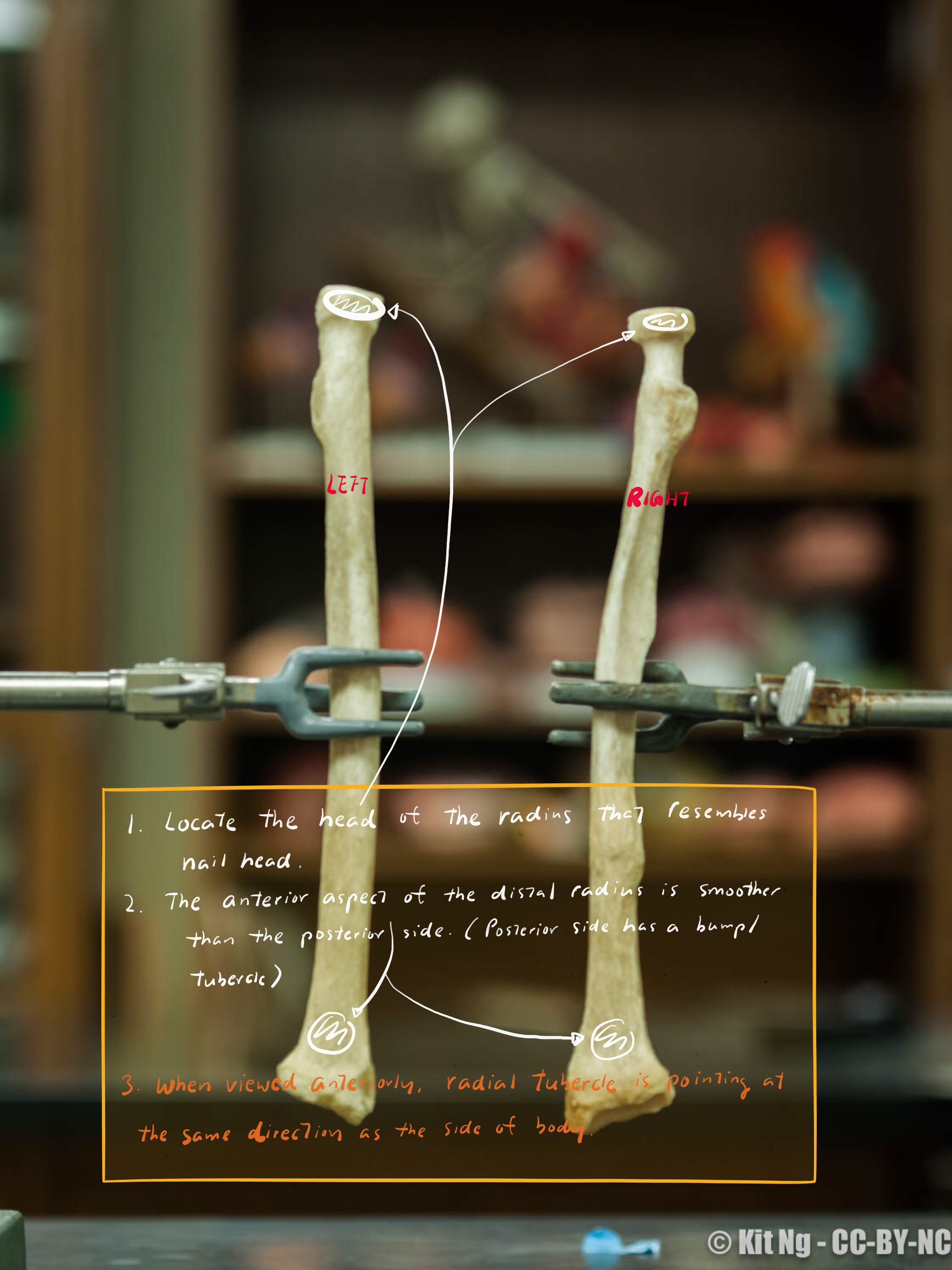 Radius – Left/Right – Kit Ng, Ph.D.